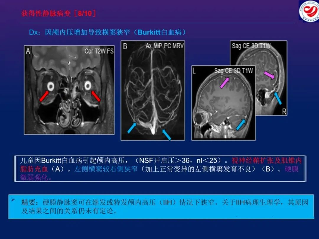影像PPT - 【PPT】小儿脑静脉影像学：包括硬脑膜静脉窦-31