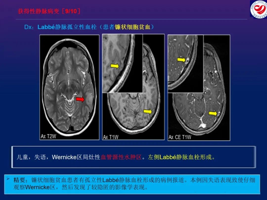 影像PPT - 【PPT】小儿脑静脉影像学：包括硬脑膜静脉窦-32