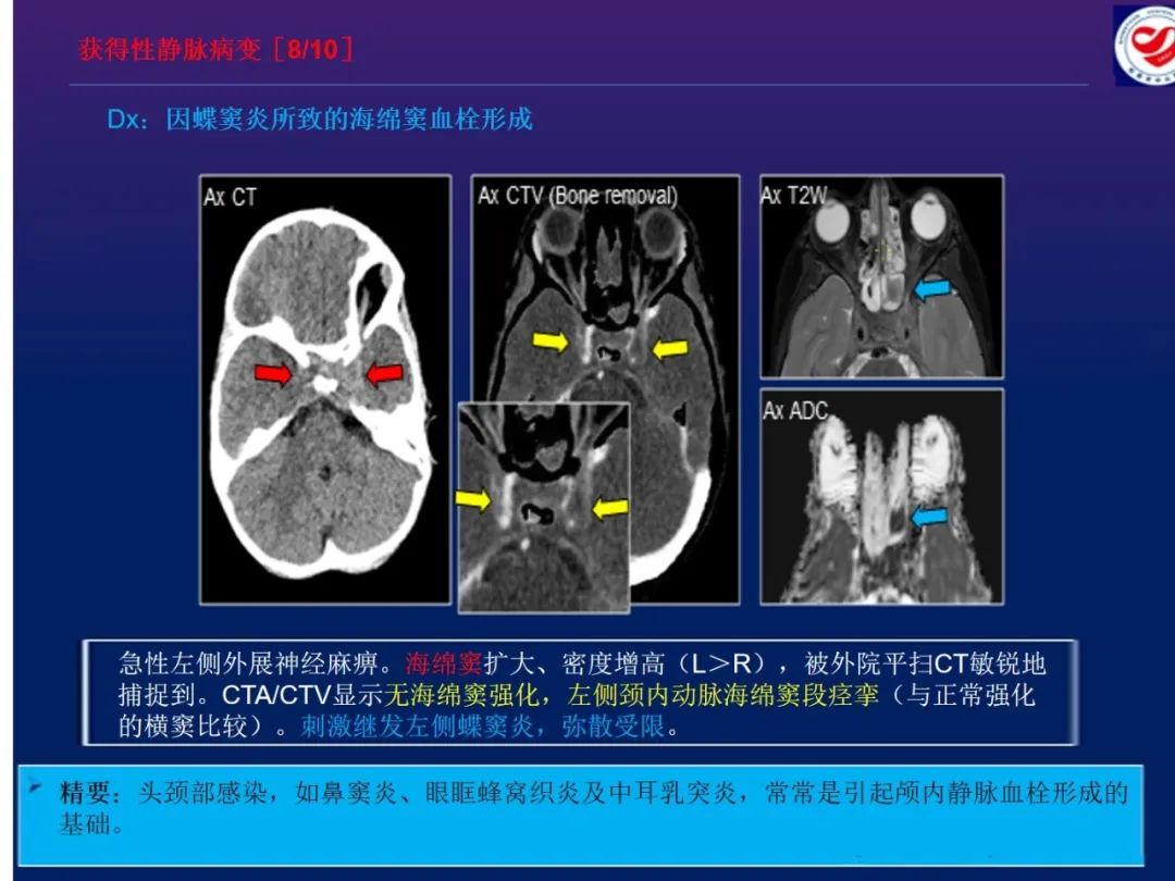 影像PPT - 【PPT】小儿脑静脉影像学：包括硬脑膜静脉窦-33