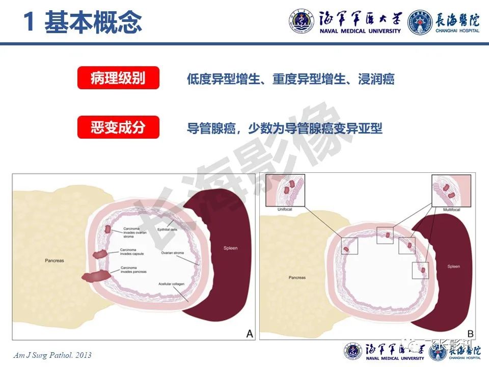 影像PPT - 【PPT】胰腺黏液性囊性肿瘤影像学评估-5