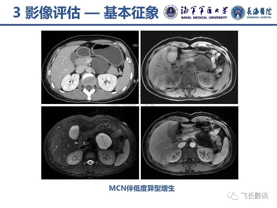 影像PPT - 【PPT】胰腺黏液性囊性肿瘤影像学评估-13