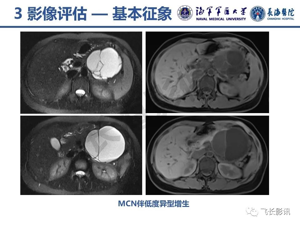 影像PPT - 【PPT】胰腺黏液性囊性肿瘤影像学评估-14