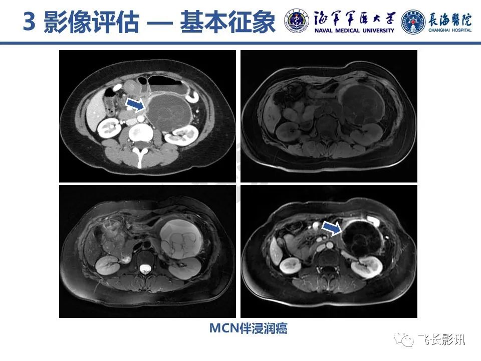 影像PPT - 【PPT】胰腺黏液性囊性肿瘤影像学评估-15
