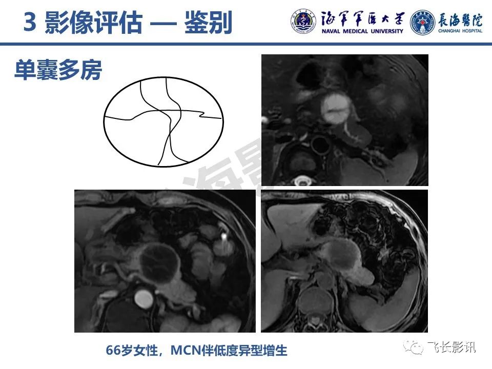影像PPT - 【PPT】胰腺黏液性囊性肿瘤影像学评估-20