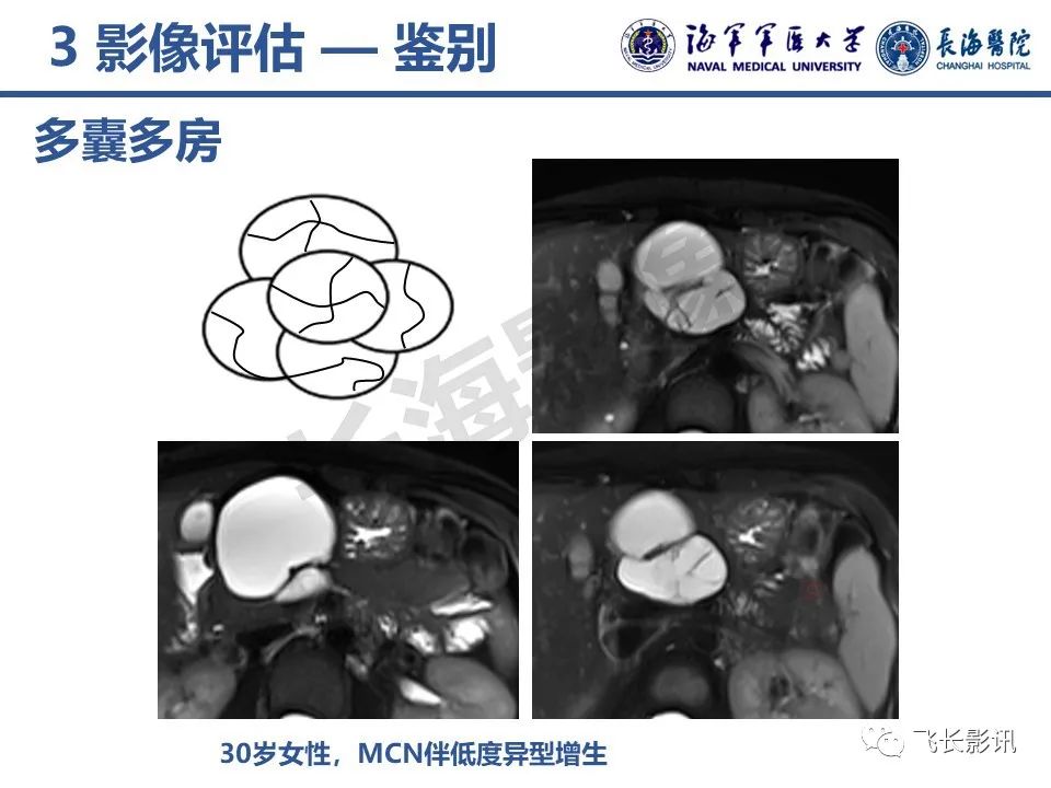 影像PPT - 【PPT】胰腺黏液性囊性肿瘤影像学评估-22