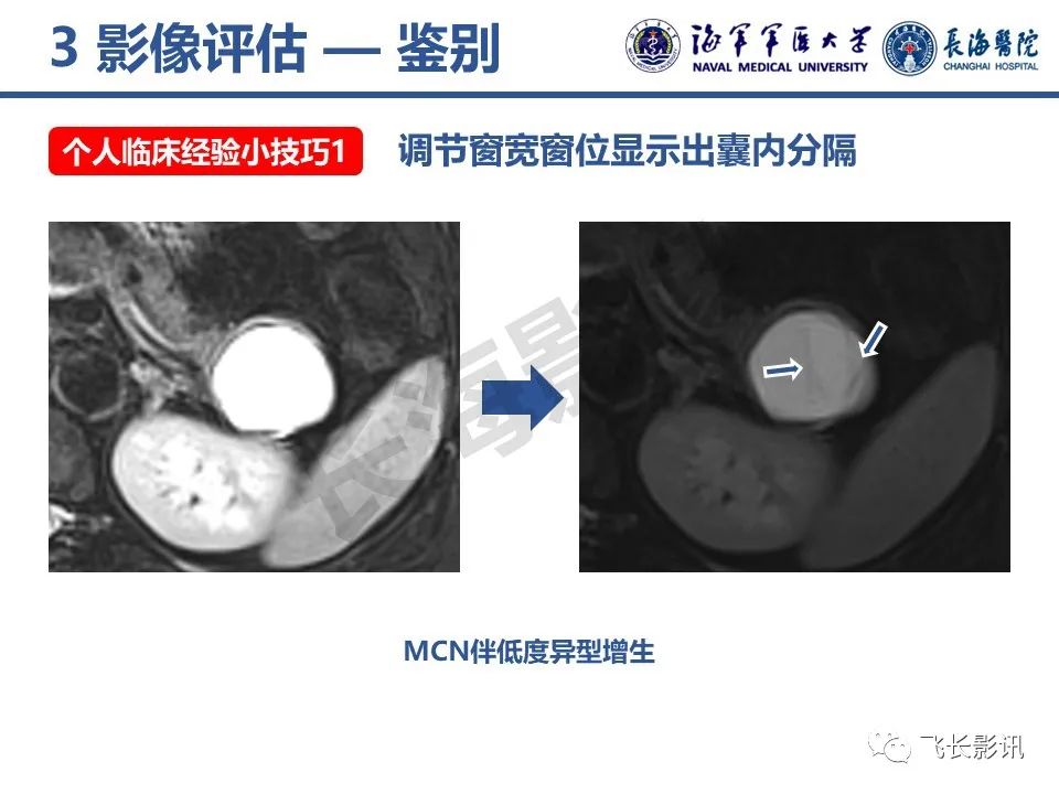 影像PPT - 【PPT】胰腺黏液性囊性肿瘤影像学评估-30