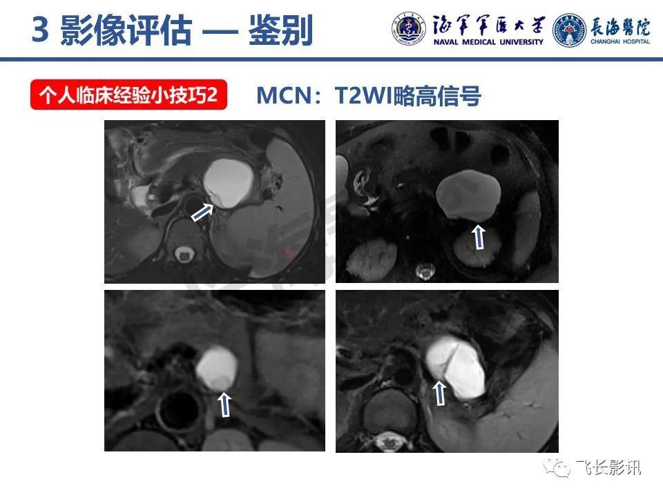 影像PPT - 【PPT】胰腺黏液性囊性肿瘤影像学评估-31