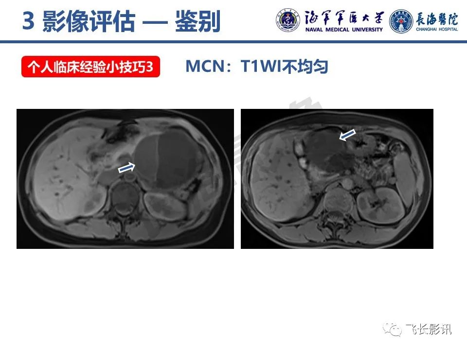 影像PPT - 【PPT】胰腺黏液性囊性肿瘤影像学评估-32