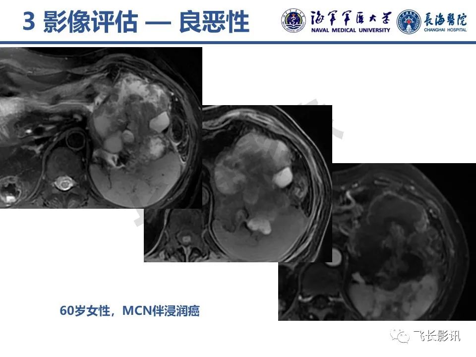 影像PPT - 【PPT】胰腺黏液性囊性肿瘤影像学评估-40