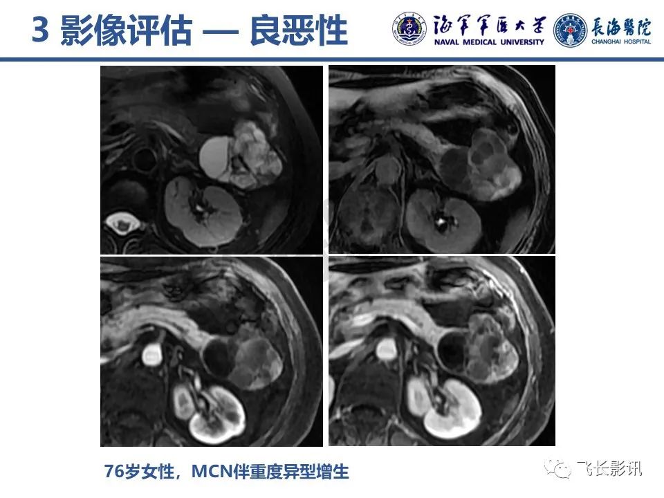 影像PPT - 【PPT】胰腺黏液性囊性肿瘤影像学评估-38