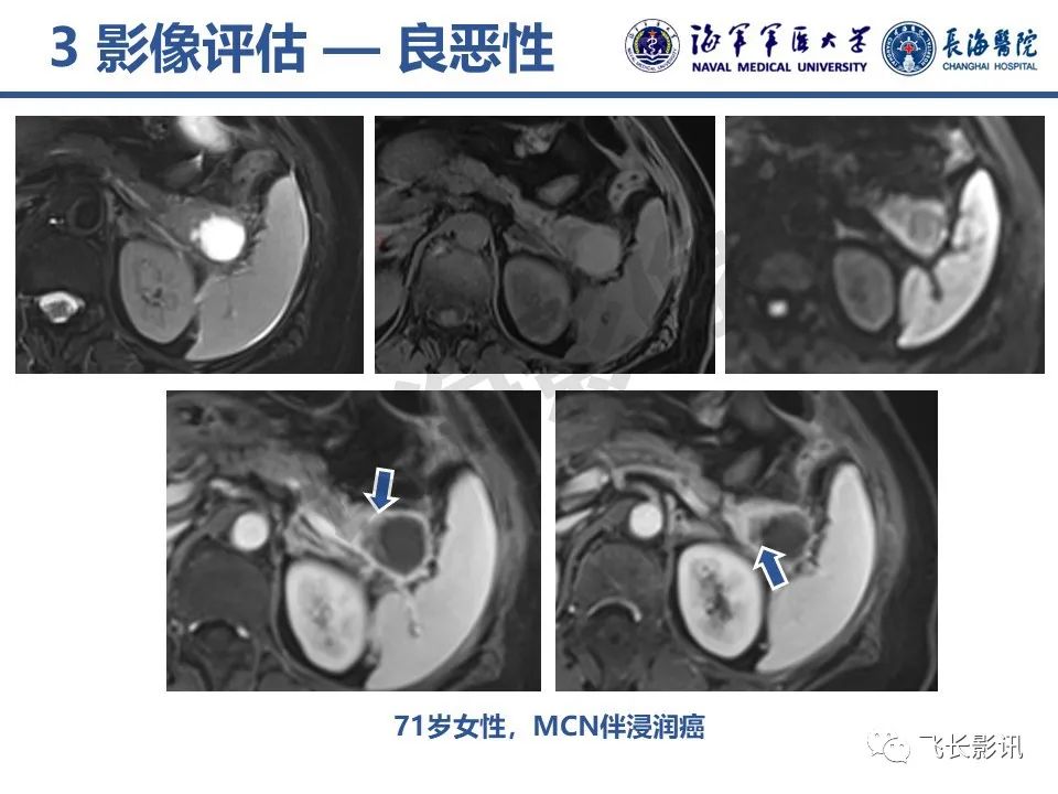 影像PPT - 【PPT】胰腺黏液性囊性肿瘤影像学评估-39