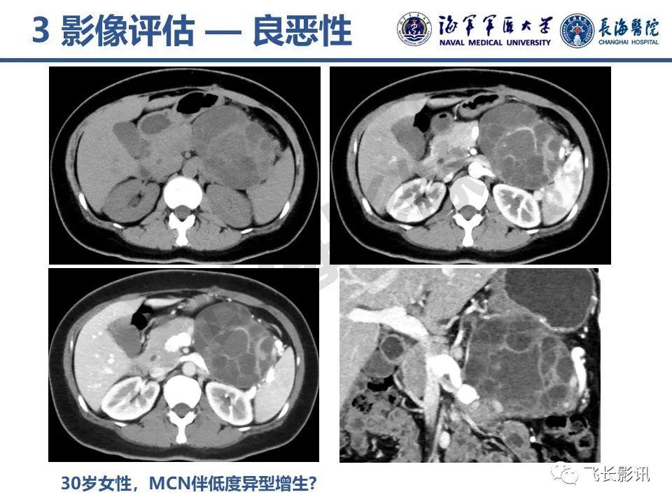 影像PPT - 【PPT】胰腺黏液性囊性肿瘤影像学评估-41