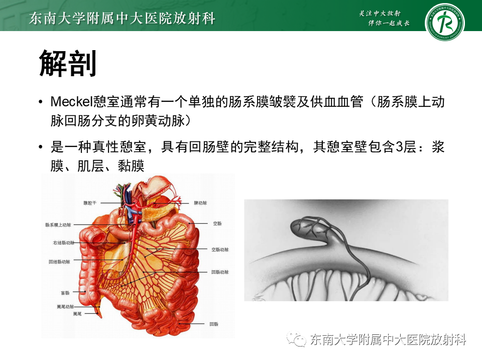 影像PPT - 【PPT】梅克尔憩室-8