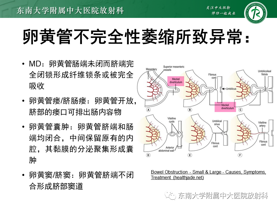 影像PPT - 【PPT】梅克尔憩室-6
