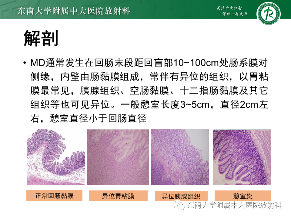 影像PPT - 【PPT】梅克尔憩室-7