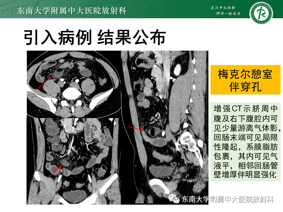 影像PPT - 【PPT】梅克尔憩室-2