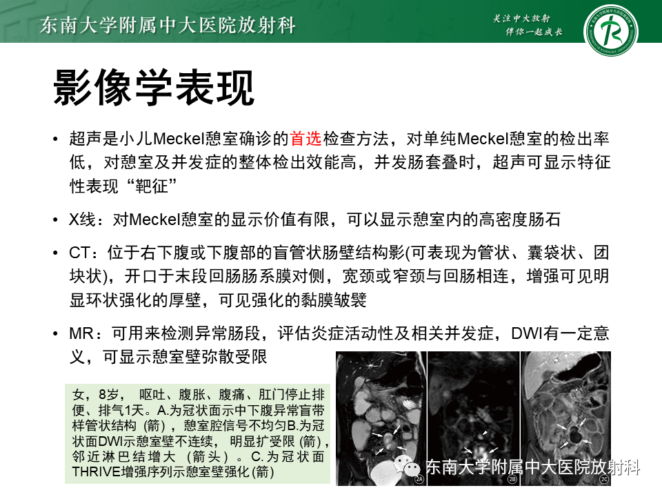 影像PPT - 【PPT】梅克尔憩室-11