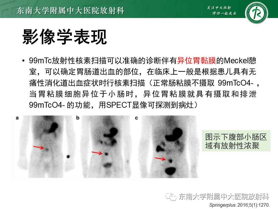 影像PPT - 【PPT】梅克尔憩室-12