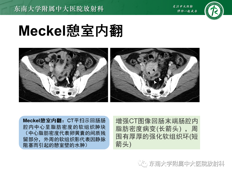 影像PPT - 【PPT】梅克尔憩室-17