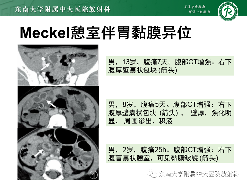 影像PPT - 【PPT】梅克尔憩室-16