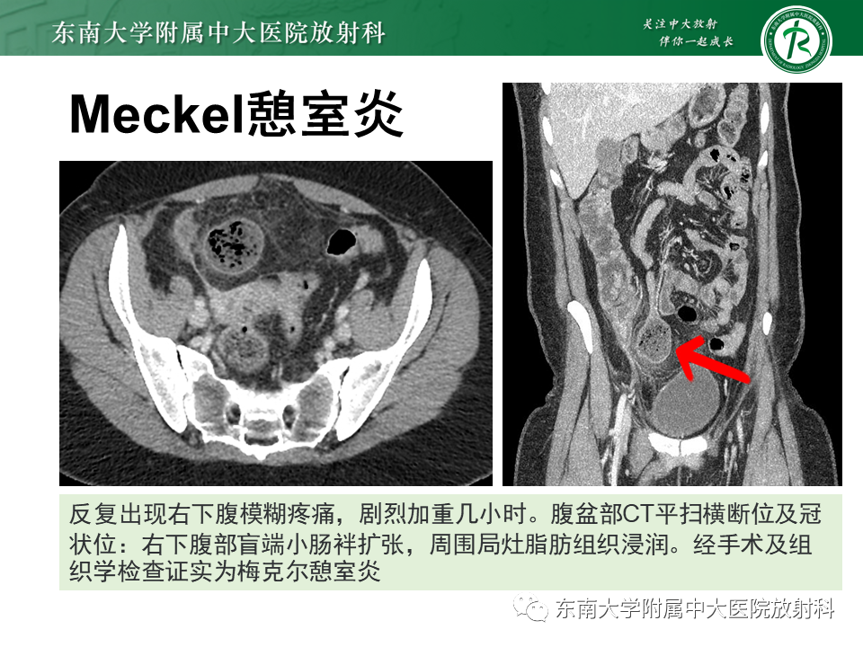 影像PPT - 【PPT】梅克尔憩室-15