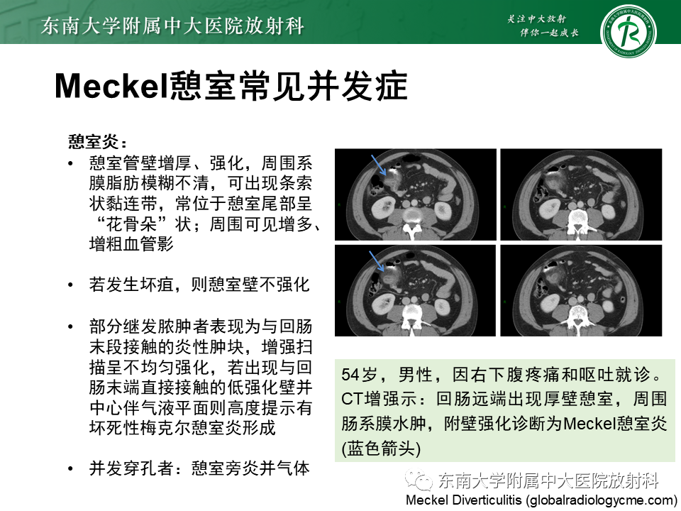影像PPT - 【PPT】梅克尔憩室-14