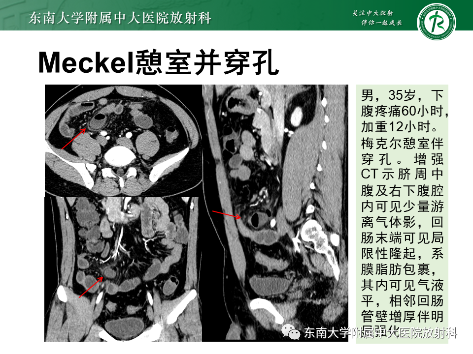 影像PPT - 【PPT】梅克尔憩室-20