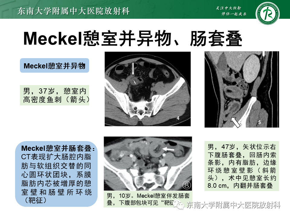 影像PPT - 【PPT】梅克尔憩室-18