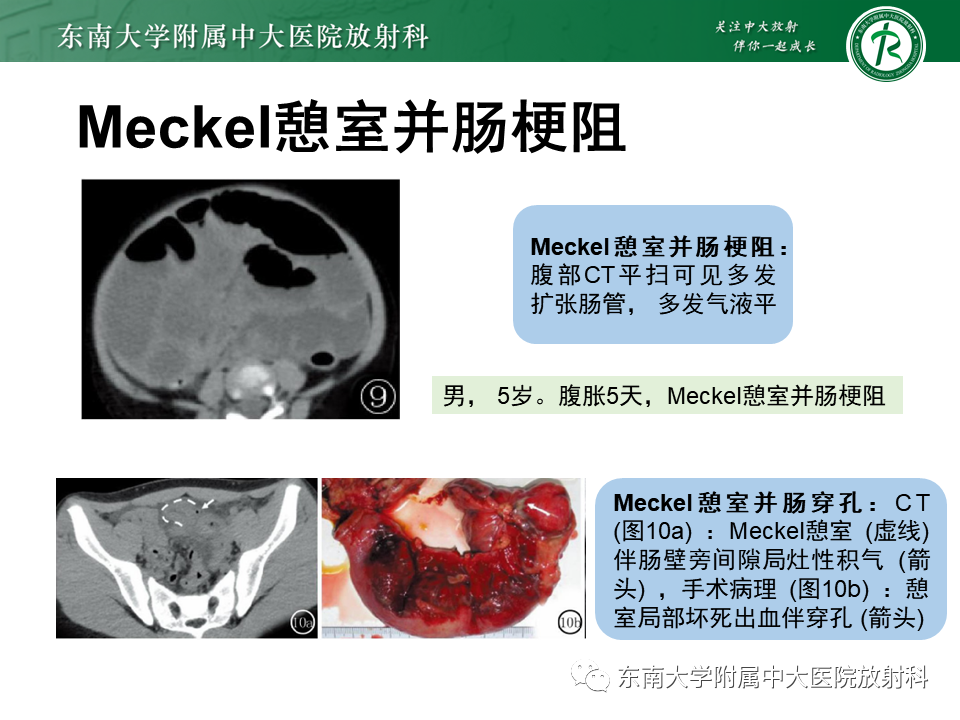 影像PPT - 【PPT】梅克尔憩室-19