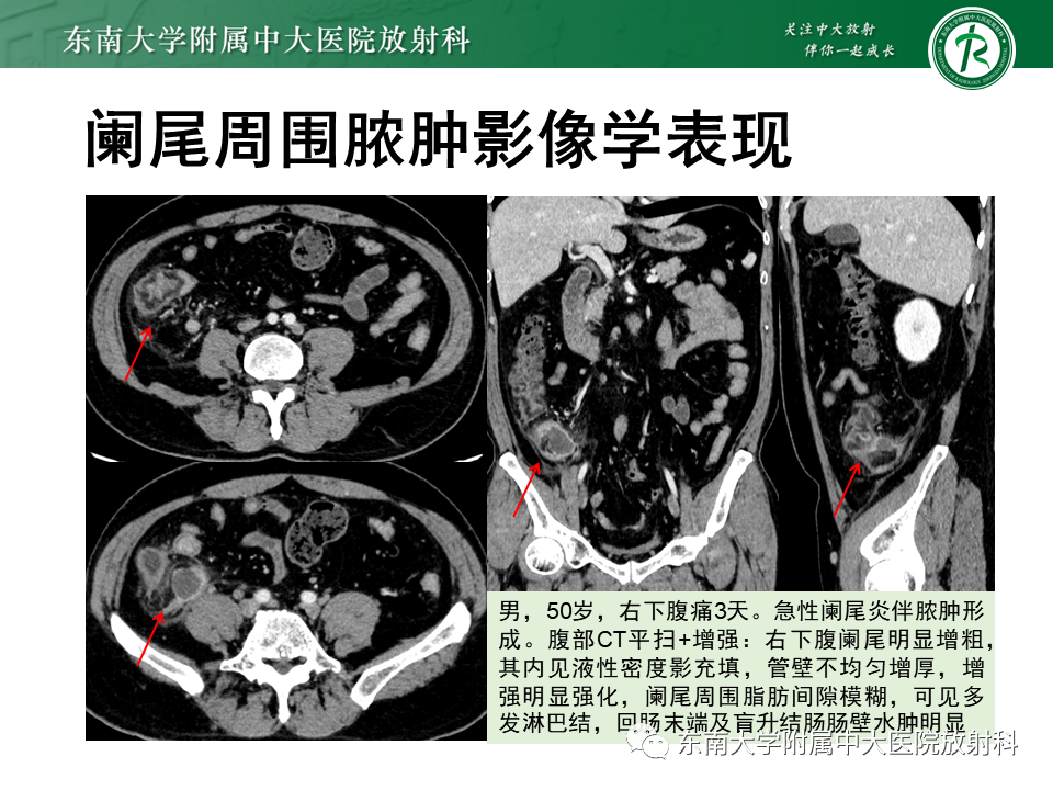 影像PPT - 【PPT】梅克尔憩室-24