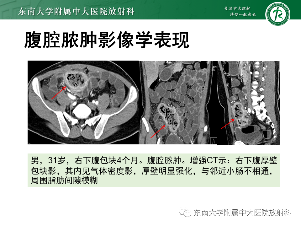 影像PPT - 【PPT】梅克尔憩室-26