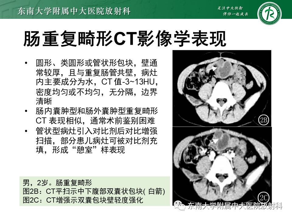 影像PPT - 【PPT】梅克尔憩室-28