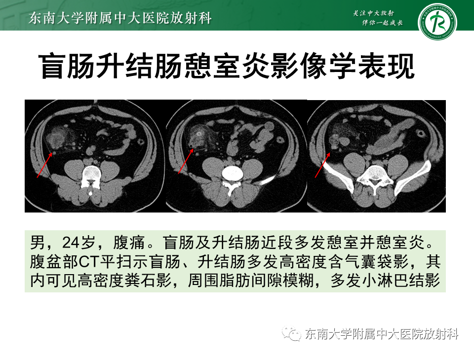 影像PPT - 【PPT】梅克尔憩室-30