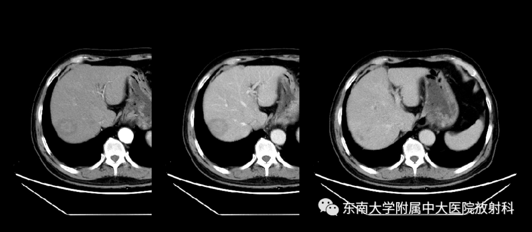 影像PPT - 【PPT】肝脏炎性肌纤维母细胞瘤-1