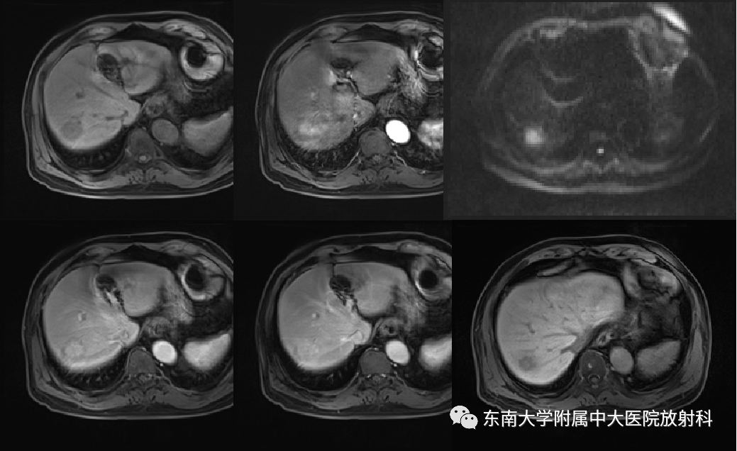 影像PPT - 【PPT】肝脏炎性肌纤维母细胞瘤-2