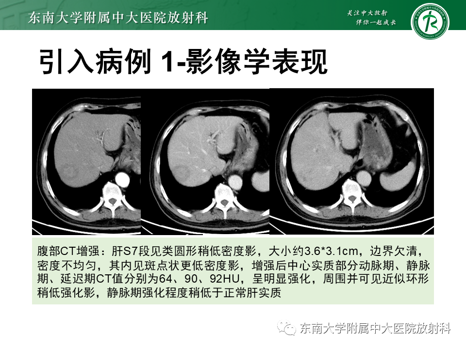影像PPT - 【PPT】肝脏炎性肌纤维母细胞瘤-3