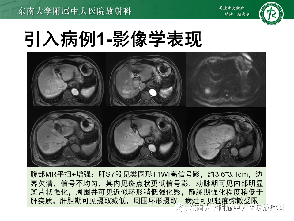 影像PPT - 【PPT】肝脏炎性肌纤维母细胞瘤-4