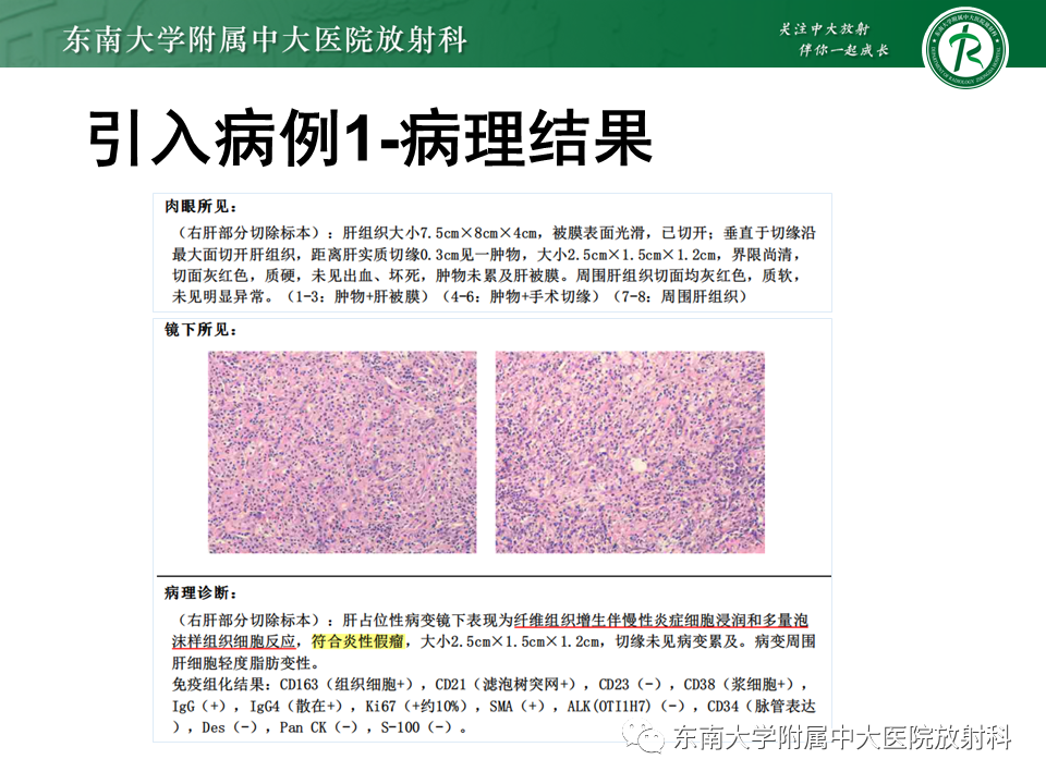 影像PPT - 【PPT】肝脏炎性肌纤维母细胞瘤-5