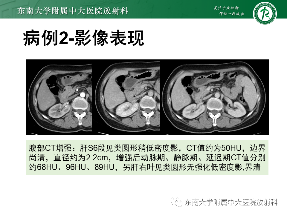 影像PPT - 【PPT】肝脏炎性肌纤维母细胞瘤-11
