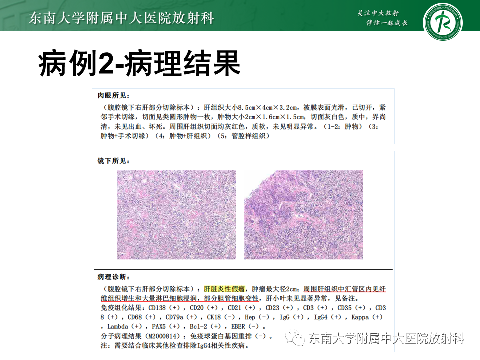 影像PPT - 【PPT】肝脏炎性肌纤维母细胞瘤-12