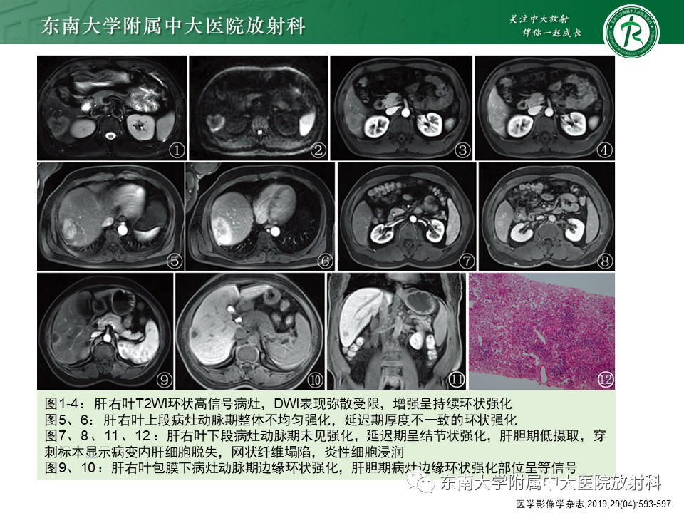 影像PPT - 【PPT】肝脏炎性肌纤维母细胞瘤-14