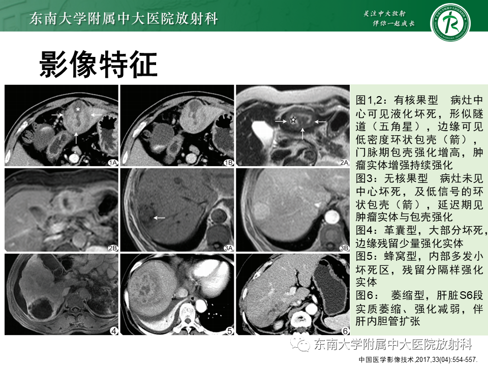 影像PPT - 【PPT】肝脏炎性肌纤维母细胞瘤-16