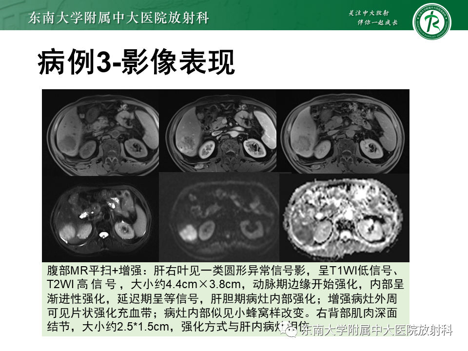 影像PPT - 【PPT】肝脏炎性肌纤维母细胞瘤-21