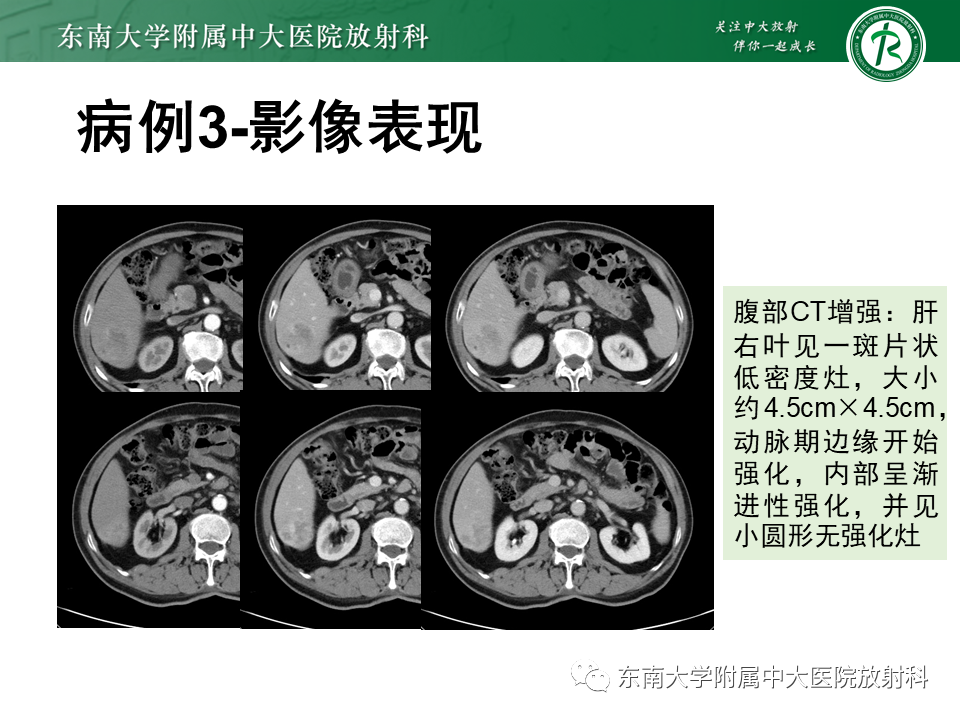 影像PPT - 【PPT】肝脏炎性肌纤维母细胞瘤-20