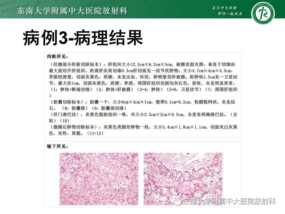 影像PPT - 【PPT】肝脏炎性肌纤维母细胞瘤-22