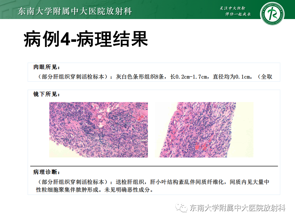 影像PPT - 【PPT】肝脏炎性肌纤维母细胞瘤-29