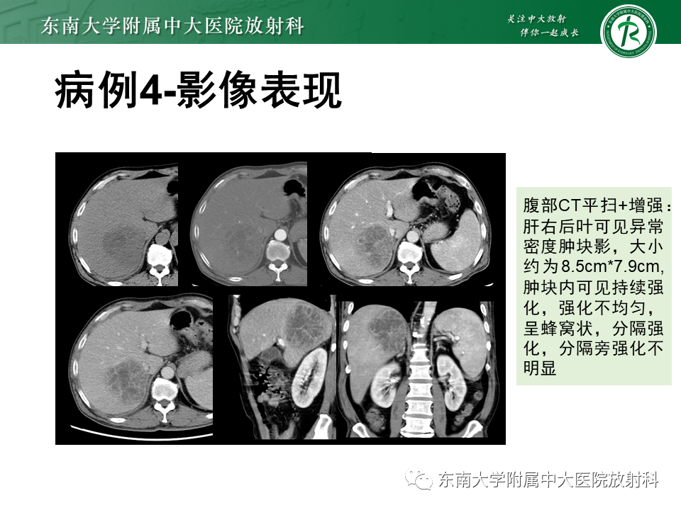 影像PPT - 【PPT】肝脏炎性肌纤维母细胞瘤-27