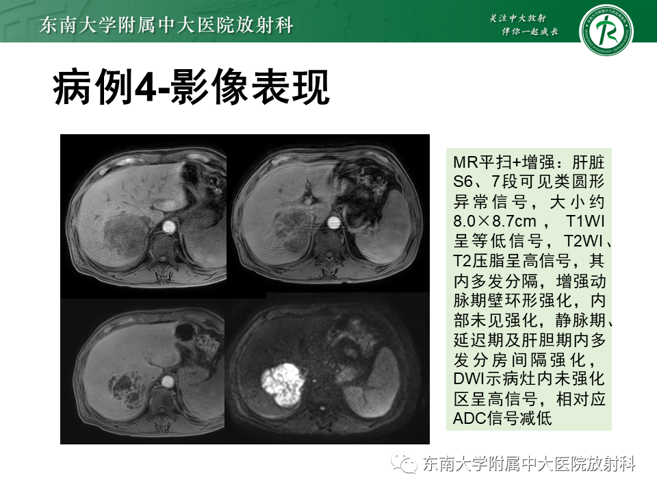 影像PPT - 【PPT】肝脏炎性肌纤维母细胞瘤-28