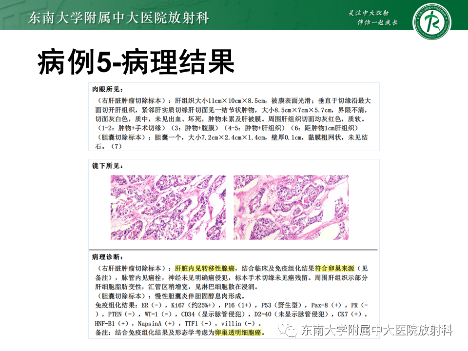 影像PPT - 【PPT】肝脏炎性肌纤维母细胞瘤-33