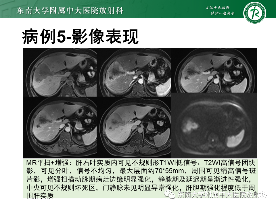 影像PPT - 【PPT】肝脏炎性肌纤维母细胞瘤-32